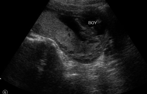 True Story: What the Ultrasound said and why I'm not convinced